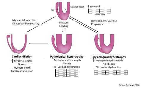心肌肥厚（hypertrophy）模型構(gòu)建